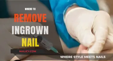 Ingrown Nail Removal: Where to Go?