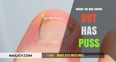 Toe Nail Infection: What to Do About Puss