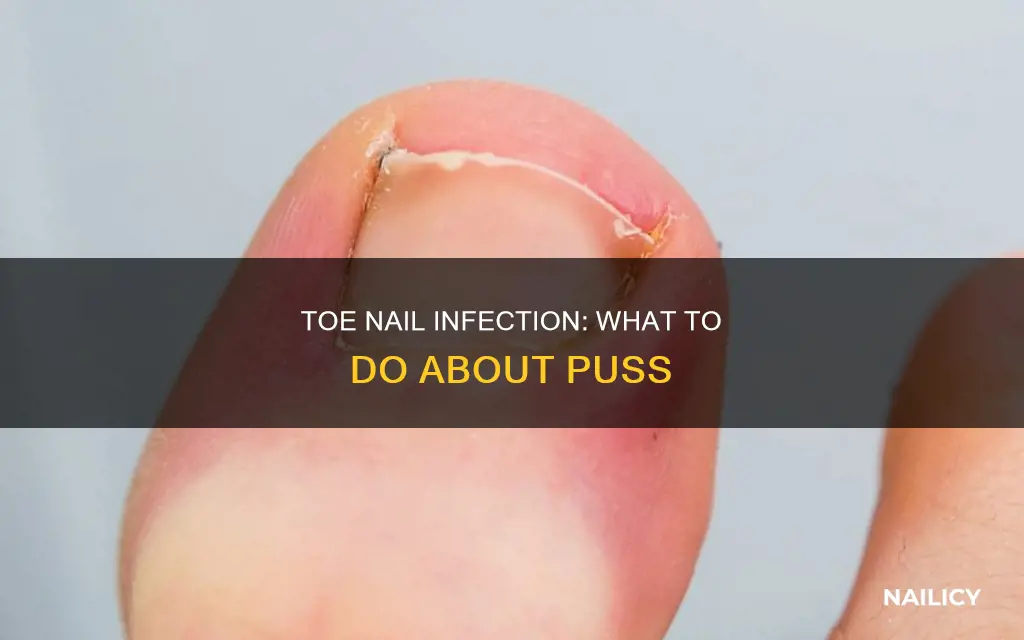 where toe nail grows out has puss