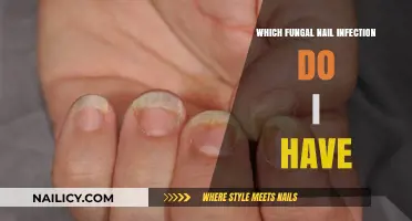 Identifying Your Fungal Nail Infection: Types, Symptoms, and Diagnosis Guide