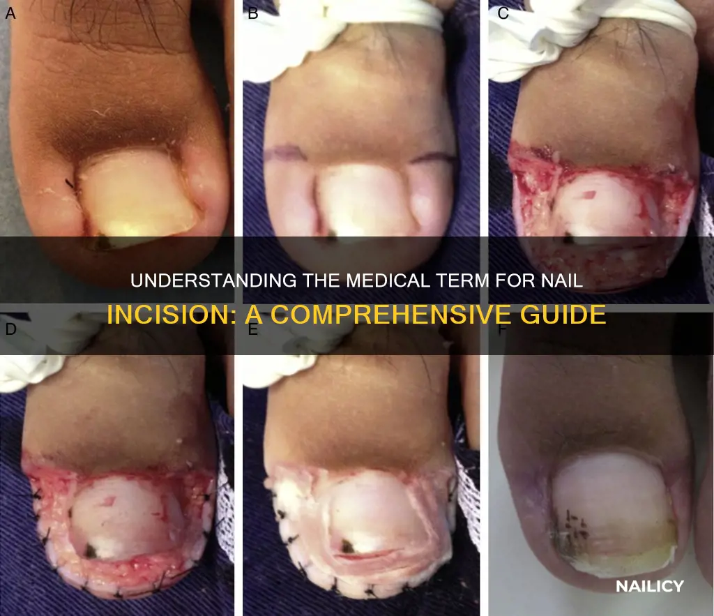 which medical term means incision into a nail