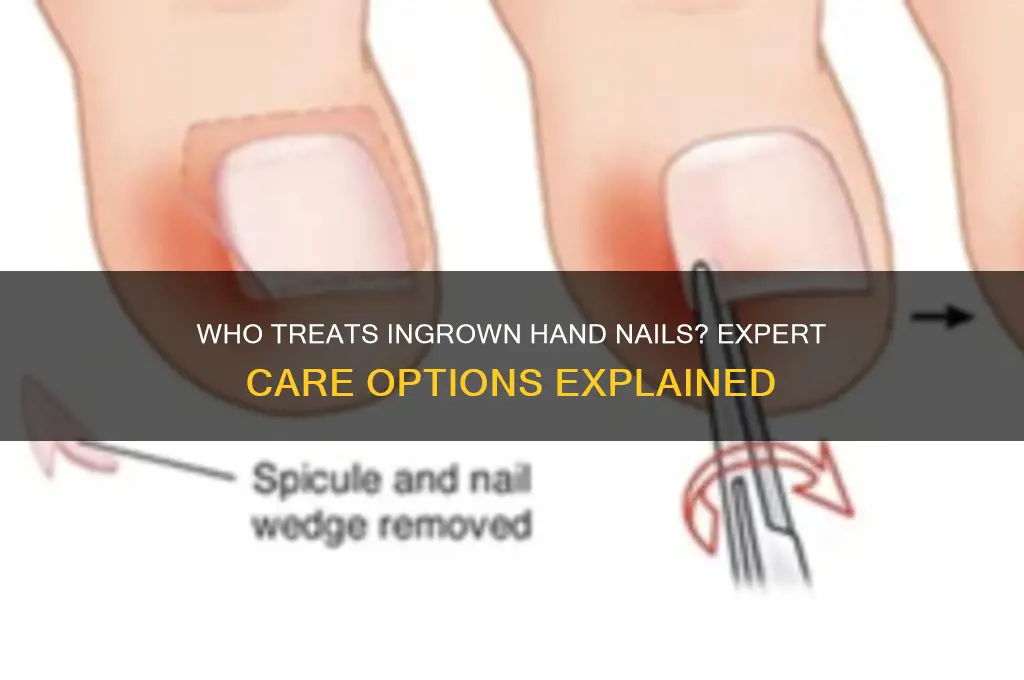 who treats new hand nail thats ingrown