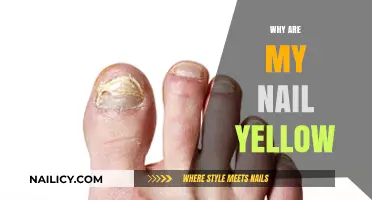Why Are My Nails Yellow? Causes, Prevention, and Treatment Options