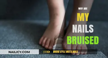 Why Are My Nails Bruised? Causes, Prevention, and Treatment Explained