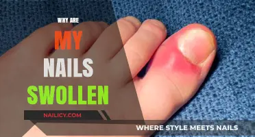 Swollen Nails: Causes, Concerns, and Effective Remedies Explained