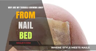Toenail Troubles: Why Are They Growing Away?