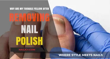 Toenail Troubles: Yellowing After Nail Polish Removal
