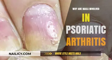 Psoriatic Arthritis and Nails: Understanding the Connection and Symptoms
