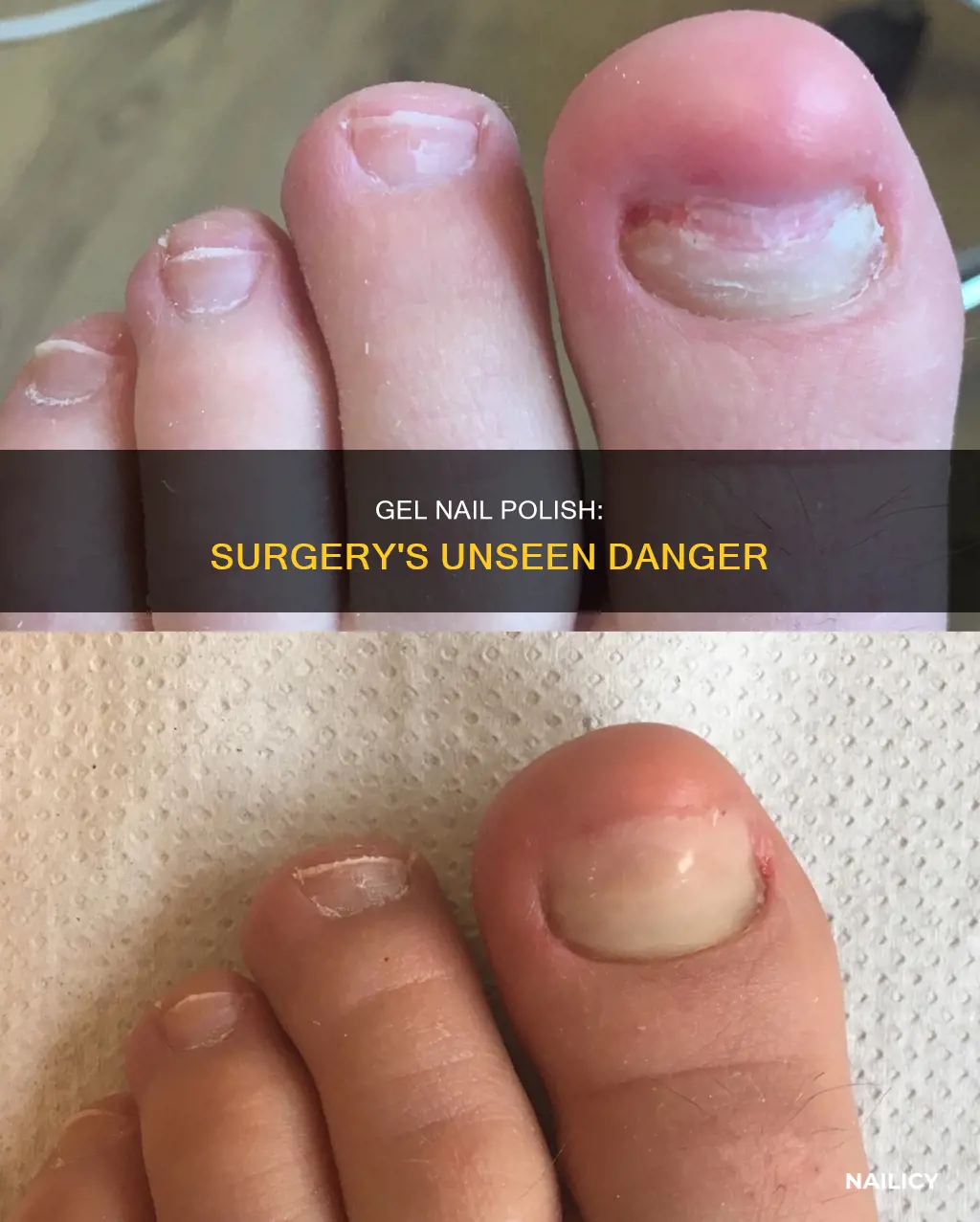 why can i not have gel nail polish during surgery
