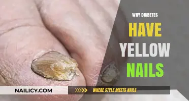 Diabetes and Yellow Nails: Uncovering the Surprising Connection