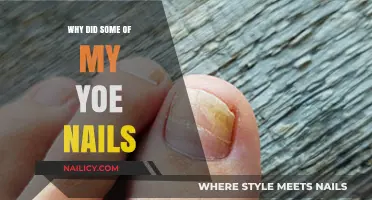 Understanding Why Some Toenails Fall Off: Causes and Solutions