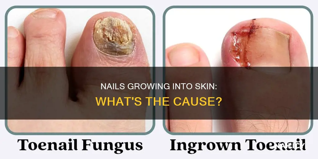 why do all of my nails grow into my skin