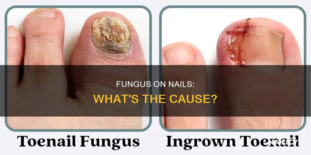 why do fungus grow on nails