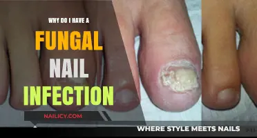 Understanding Fungal Nail Infections: Causes, Symptoms, and Prevention Tips