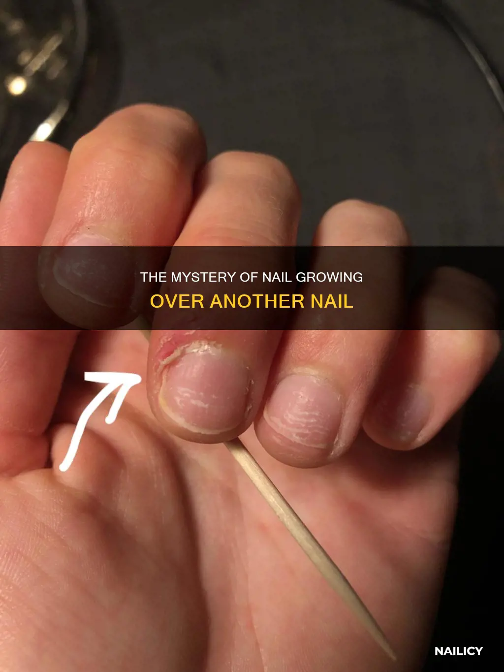 why do i have a nail growing over my nail