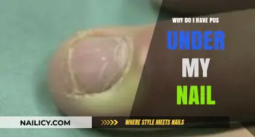 Pus Under Nail: Causes, Symptoms, and Effective Treatment Options Explained