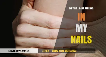 Streaks in Your Nails: Causes, Concerns, and Solutions Explained