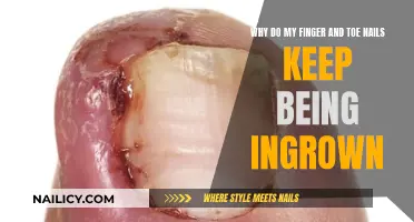 How to Prevent Nails from Becoming Ingrown