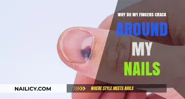 Why Do My Fingers Crack Around My Nails? Causes and Solutions