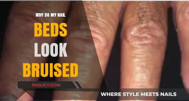 Why Do My Nail Beds Look Bruised? Causes and Solutions