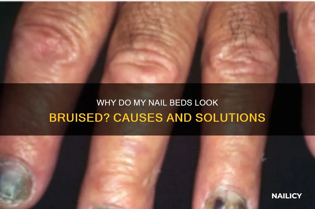 why do my nail beds look bruised