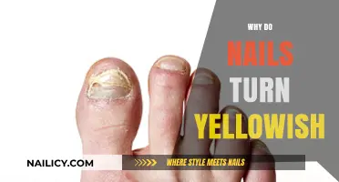 Why Do Nails Turn Yellowish? Causes, Prevention, and Treatment Options