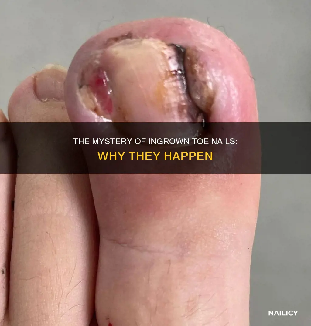why do people grow ingrown toe nails