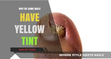 Why Some Nails Turn Yellow: Causes and Solutions Explained