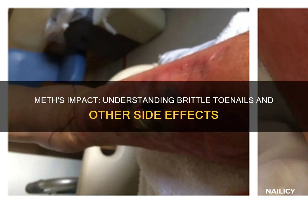why does meth make my toe nails brittle