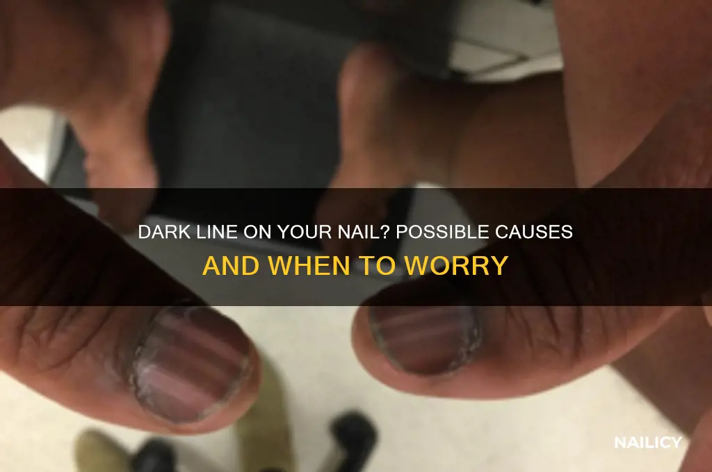 Dark Line On Your Nail? Possible Causes And When To Worry | Nailicy