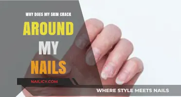 Why Skin Cracks Around Nails: Causes and Solutions Explained