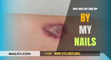 Why Skin Tears Near Nails: Causes, Prevention, and Solutions