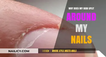 Why Skin Splits Around Nails: Causes and Solutions Explained