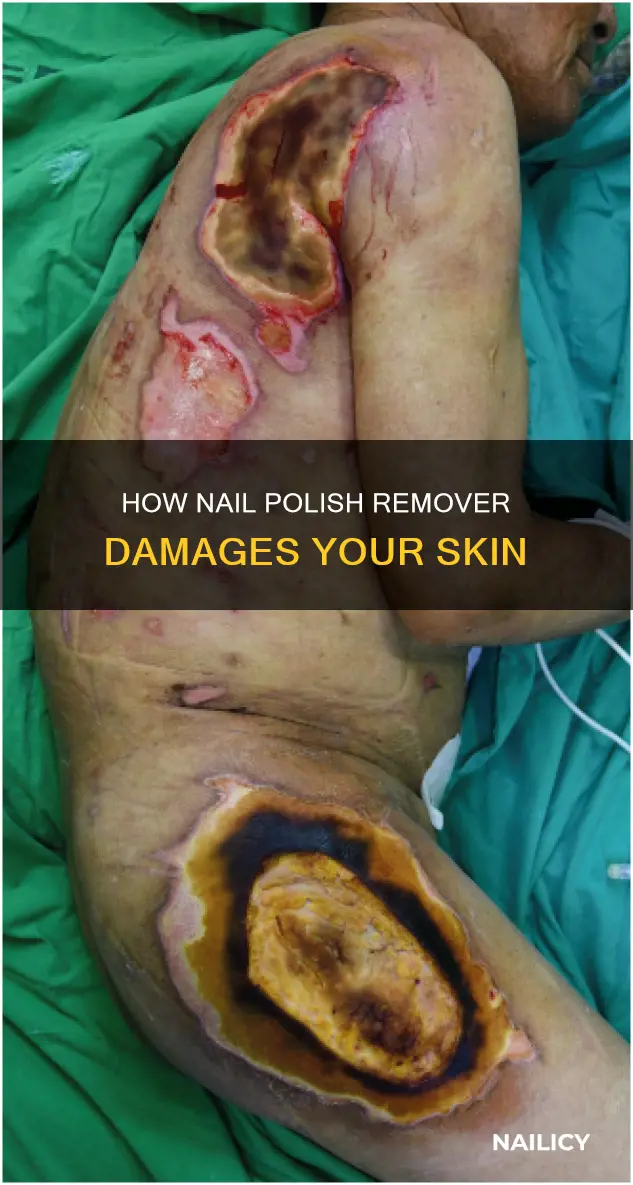 why does nail polish remover make my skin peel