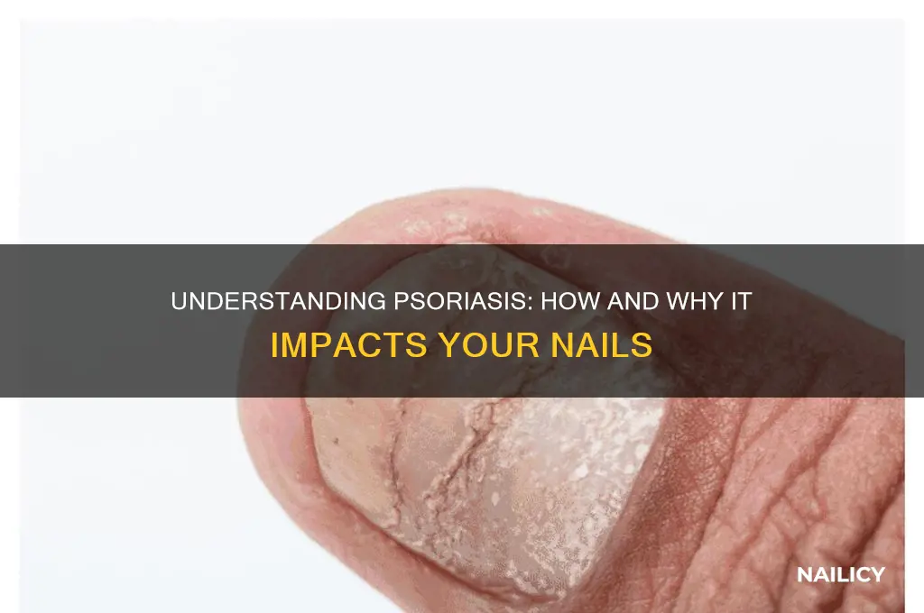 why does psoriasis affect nails