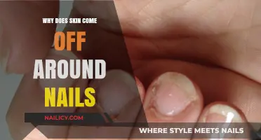 Why Skin Peels Around Nails: Causes and Solutions Explained