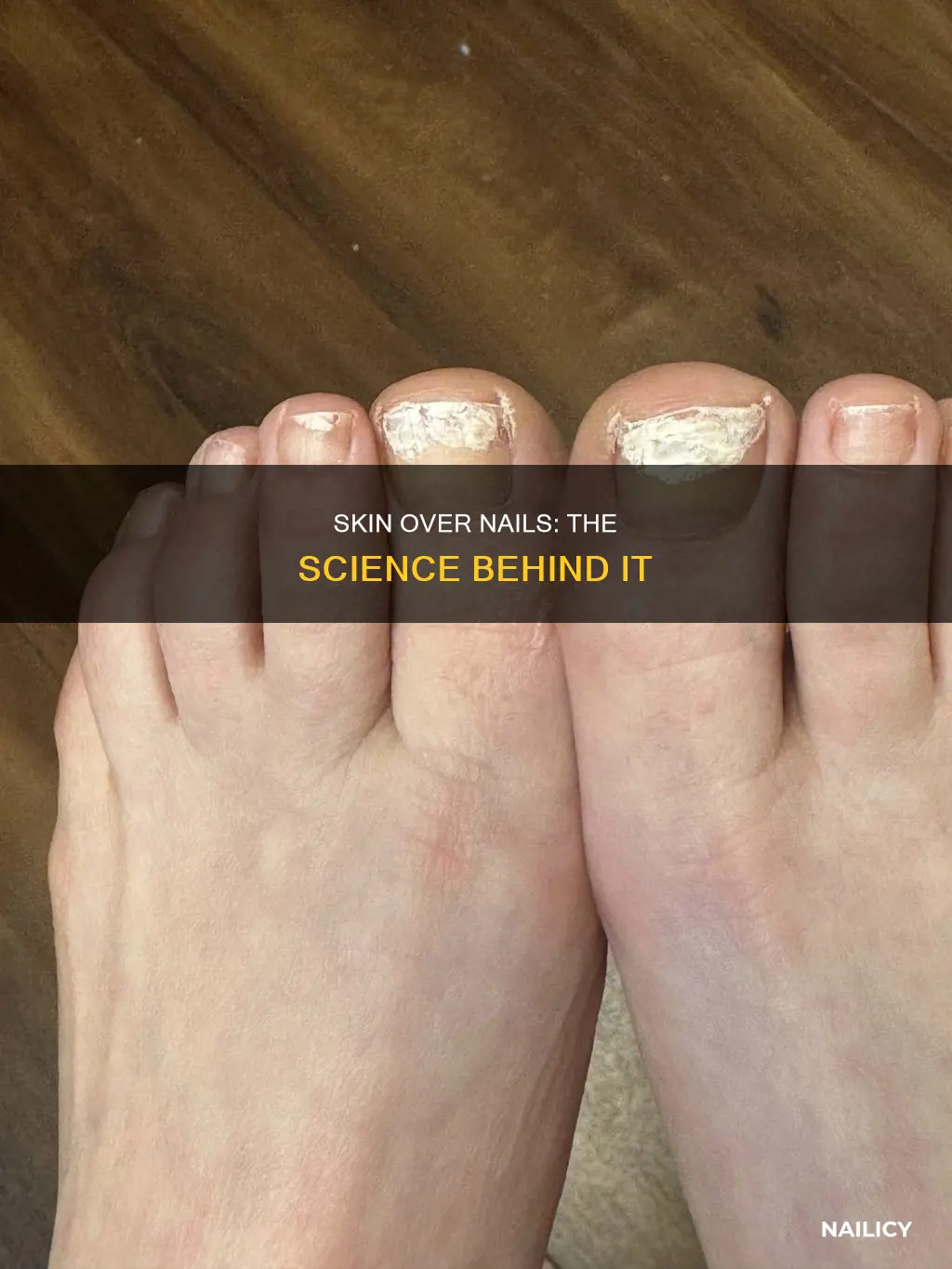 why does skin grow over nails