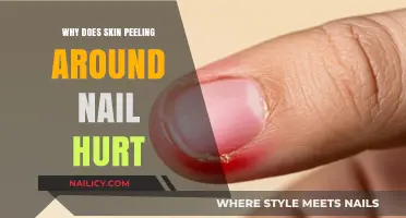Why Skin Peeling Around Nails Causes Pain and Discomfort