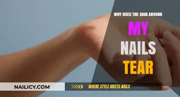 Why Does the Skin Around My Nails Tear? Causes and Solutions