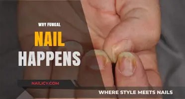 Understanding Fungal Nail Infections: Causes, Risks, and Prevention Tips