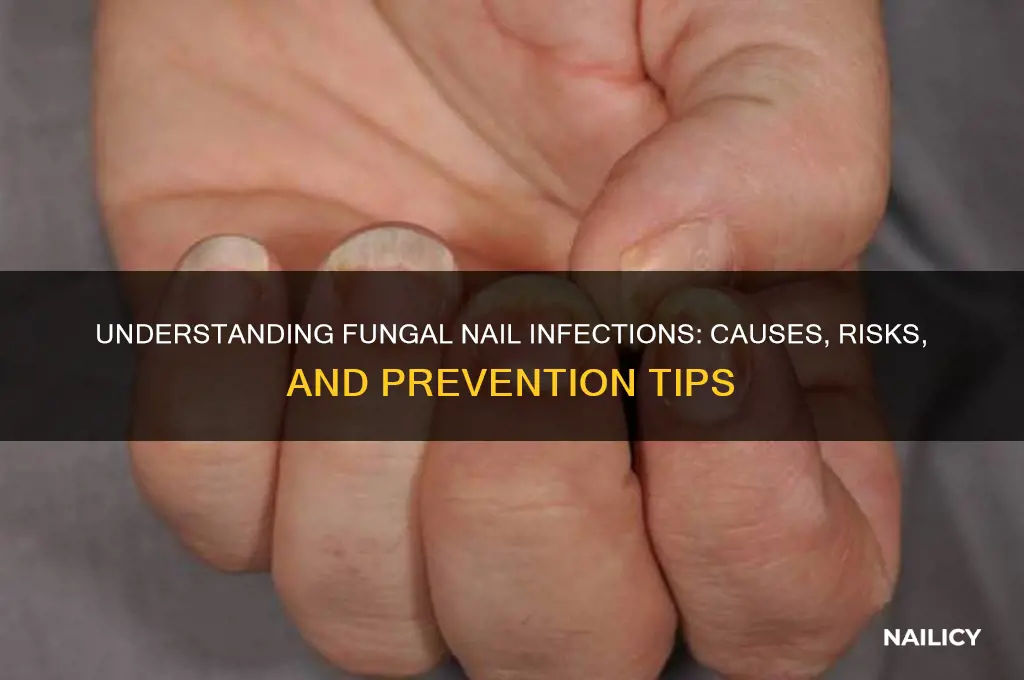 why fungal nail happens