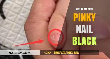 Why Is My Pinky Toenail Black? Causes and Solutions Explained