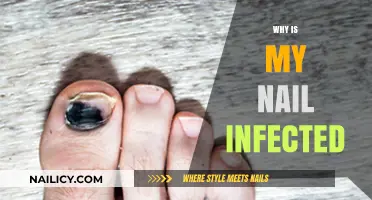 Understanding Nail Infections: Causes, Symptoms, and Effective Treatment Options
