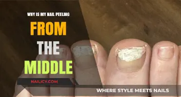 Why Is My Nail Peeling from the Middle? Causes and Solutions