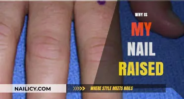 Why Is My Nail Raised? Causes, Concerns, and Treatment Options