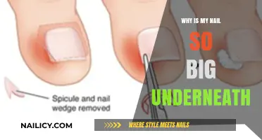 Why Is My Nail So Big Underneath? Causes and Solutions