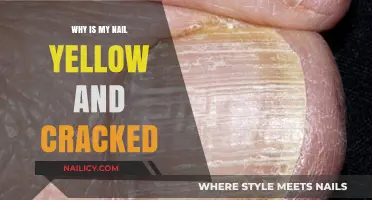 Yellow, Cracked Nails: Causes, Concerns, and Effective Treatment Solutions