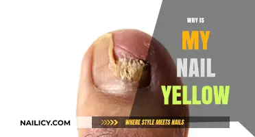 Why Are My Nails Yellow? Causes, Concerns, and Solutions Explained