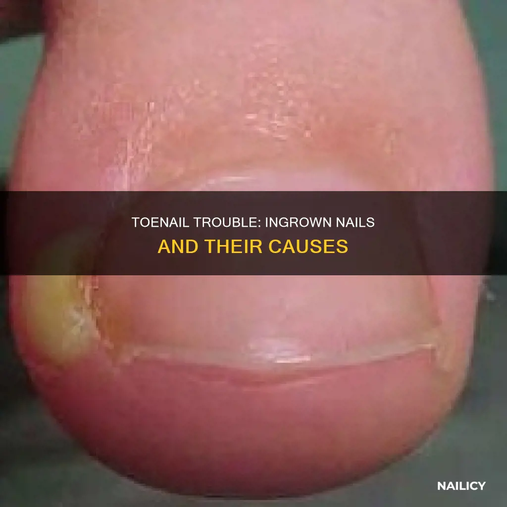 why is my second toenail growing into nail bed