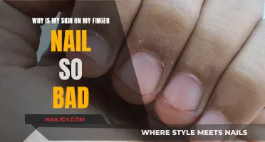 Understanding Dry Skin Around Fingernails